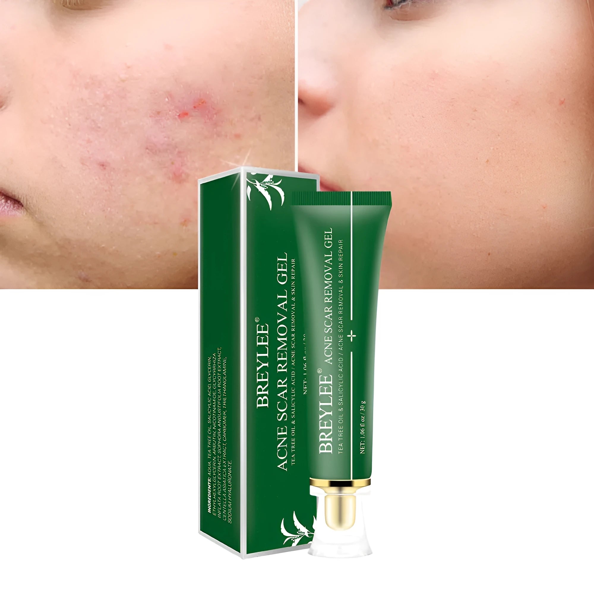 Green acne scar removal gel in a compact tube with tea tree extract for blemish treatment