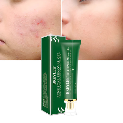 Green acne scar removal gel in a compact tube with tea tree extract for blemish treatment
