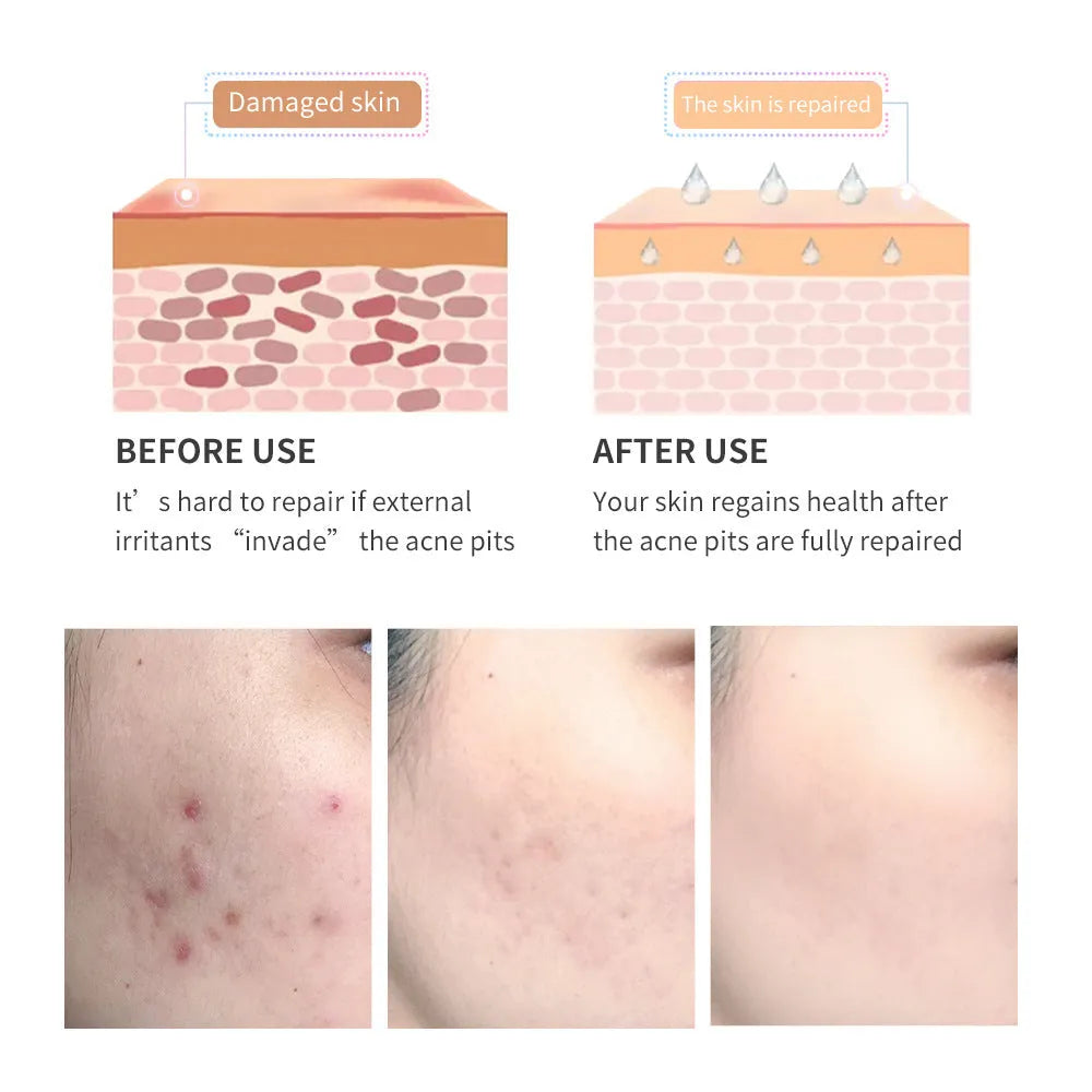 Green acne scar removal gel in a compact tube with tea tree extract for blemish treatment