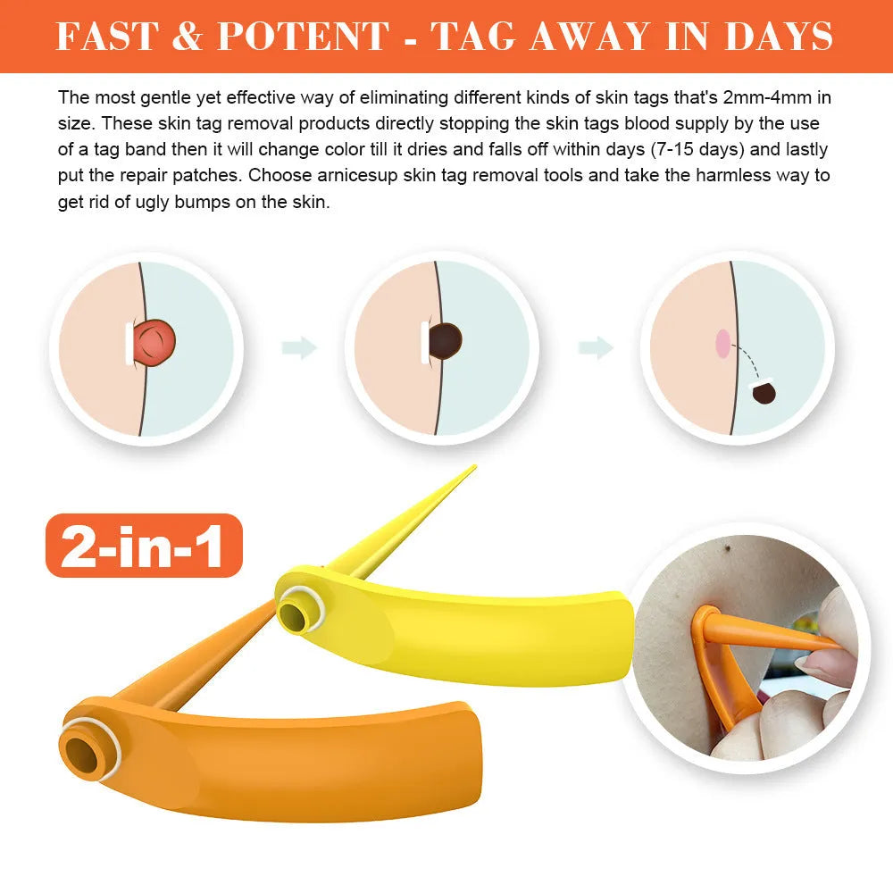 Orange yellow wart removal tool kit with cones, rubber rings, alcohol swabs and instruction manual