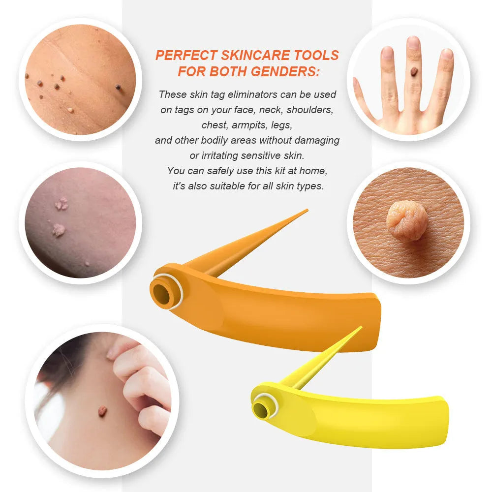 Orange yellow wart removal tool kit with cones, rubber rings, alcohol swabs and instruction manual